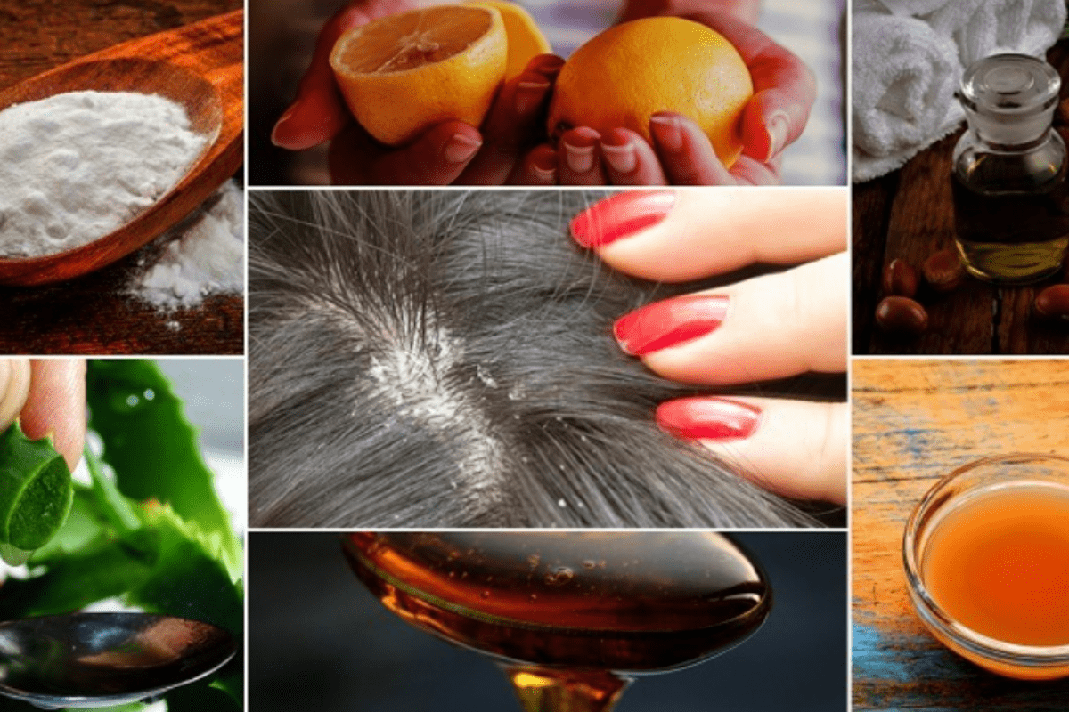 Žiadne šampóny a chemikálie: zbavte sa lupín pomocou tejto koreniny, ktorú už máte doma.