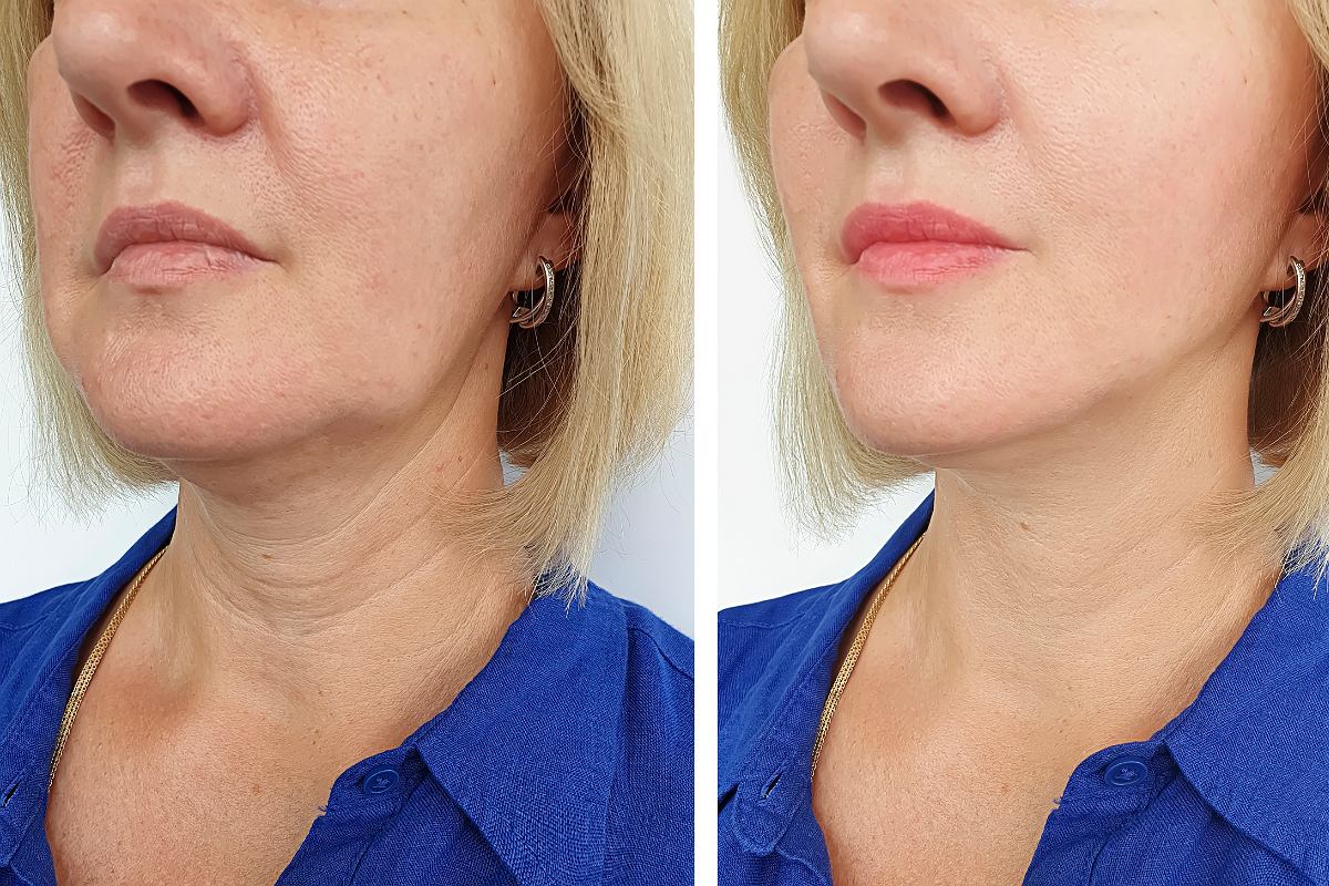 Ako vyhladzovať vrásky na krku a rýchlo obnoviť pružnosť pokožky v domácom prostredí